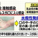 手足口病(수족구병) 여름에 유행 소독 보다는 손을 잘 씻는게 이미지