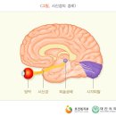 시신경염optic neuritis , 視神經炎 이미지