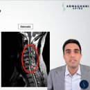 “경추 척수증(Cervical Myelopathy) – 무엇인가? 어떻게 치료할 수 있는가?” 이미지