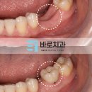 [공지] 대구 임플란트 전 iGBR 골이식으로 치조골을 회복한 케이스
