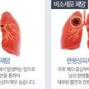 폐암 종류와 위험 요인 초기 증상 생존율은? 이미지