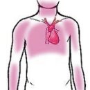 심장마비 경보 협심증과 심근경색 이미지