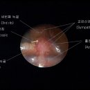 교감신경 절제술 (T4 Sympathectomy)동영상입니다. 이미지