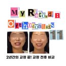 궁치과병원 | 나의 치아교정 기록기11 - 교정 끝! 교정 전후 비교 사진