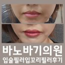 6212 | 대전 바노바기의원 입술필러 찐후기