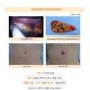 만성담낭염수술후기. 무지막지한 위쪽 통증이나 위경련이라 생각했는데 3년전 심한통증으로 초음파 검사를 하니 담석증... 이미지