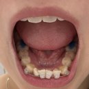 바르다윤치과의원 | 건대 성인교정치과 발품, 성인 교정 후기 -2(치아모양 많음.. 주의해주세요~~) 건대 바르다 치과 내돈내산