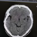 열공성 뇌경색[lacunar infarction] 이미지