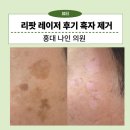 나인의원 | 홍대 나인의원 흑자 리팟레이저 내돈내산 후기