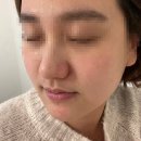 메디 바로 | 부평피부관리샵 데자뷰메디스킨 인천점 아쿠아필 후기