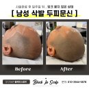 도트인스칼프
