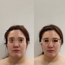 아벨라뷰티 - 도봉구 | 대전 윤곽관리 추천 탄방동 아벨라뷰티 온업리프팅 후기