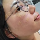 조용길의원 | [일상] 기장 조용길의원 &#34;잡티제거&#34; 1회차 시술!!