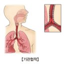 기관 협착(Stenosis of trachea) 호흡기질환 이란? 이미지