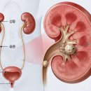 의료법인 아주효성의료재단 효성요양병원 | 여름철 주의해야 할 요로결석 신호