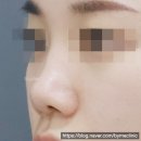 차이성형외과의원 | 코프팅 흉터 생기나요? 신논현 성형외과 전문의가 알려주는 코프팅 전후 리얼 후기