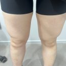 성수 작은목욕탕 | 성수지방분해주사 성수다이어트병원 허벅지 제팻주 2주차 후기