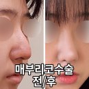 다듬성형외과의원 | 매부리코성형, 무보형물코수술로 가능?!