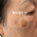 박의원 | 70대 엄마가 직접 받은 강남 흑자 리팟레이저 , 신논현역 예쁨주의쁨의원 피부과 솔직 후기