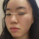 융한의원 | 서면 피부과 및 한의원에서 여드름, 편평사마귀 제거 내돈내산 솔직, 가격 후기