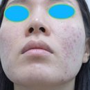 131 | 셀라딕스 131 앰플 사용법 여드름 사용후기