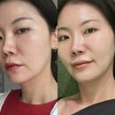 (주)청담위생개발 | 청담피부과 하이퍼 티타늄 레이저 리프팅 내돈내산 후기 / 심부볼 개선 솔직 효과
