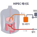 하이펙(HIPEC), 3-4기 난소암 치료에 효과 확인 ​ 이미지