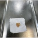 코모코한의원 | 코 안에 생겼던 물혹 비수술로 제거한 후기