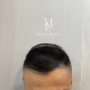 도트인스칼프 이미지
