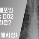 기관지 폐포암[bronchioloalveolar carcinoma] 이미지