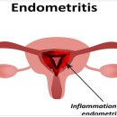자궁내막염[endometritis] 이미지