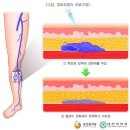 외모개선 목적의 다리정맥류 수술[2016년 1월 1일 이후 실손의료비보험 약관] 이미지