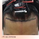 976 | 인천 맘모스 비절개 모발이식, 30대 남자 탈모 976모낭 수술 기록 후기