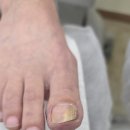 후네일 | 진주 평거동 내성발톱 무좀까지 있던 발톱 후네일에서 관리받은 후기