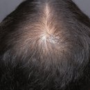 운정제일여성의원 | 운정탈모병원 줄기세포 탈모치료 3개월 후기 ｜ 리제네라액티바 실제 변화