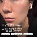 34 | 대구동성로피부과 스킨부스터 스템셀 34받은 찐 후기