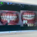 W치과의원 | 레브치과 치아미백 받고 온 후기