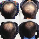 노원 블래스유 4세대 모발성장술이 대세인 이유