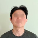 세종이마트믿음약국 | 세종뷰티의원 편평사마귀 제거 후기 경과 비용