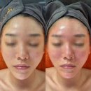 논현2-118 | 강남 논현 피부관리 나날스킨 슈퍼젝션 부작용 2회차 유지기간 솔직후기