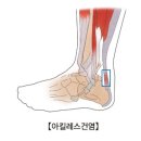 아킬레스건염과 싸운 후기