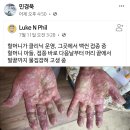 백신 접종후 온몸에 물집 이미지