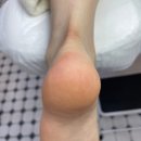 덕천빌딩 | 부산 덕천 발각질제거 케어 아기발 된 후기 부레푸스 덕천점