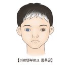 바르덴부르크 증후군(Waardenburg syndrome)유전질환이란? 이미지