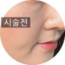 멍꿀잠 | 대구 리쥬란 엘라비에 리투오 붓기 멍 솔직 한달 후기