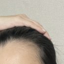 운동센터 라인 | 대구두피문신 SMP 후기｜JK두피관리센터 헤어라인 관리 후기