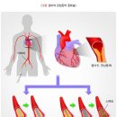 허혈성심장질환 수술비(25%체증형) 보장 특별약관(보험금의 지급사유) 이미지