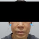 중동고등학교 | GPT 토닝 후기 지속된 난치성 색소 병변을 옅게 만든 사례