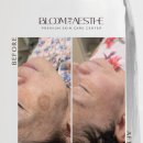 더굿플랜 | 거울 볼 때마다 스트레스인 피부 잡티, 블룸더에스떼 무제한 케어