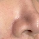 달홀약국 | 셀프 mts 1.5 2번째 후기 코 세로 모공 줄이는법